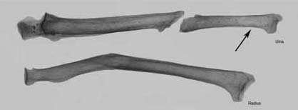 Figure 5: Right forearm from Hunal Tomb. Radius and Ulna are labeled, with arrow illustrating the location of cortical thinning of the distal ulna.
