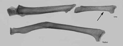 Figura 5: Antebrazo derecho de la tumba Hunal. El radio y la ulna están marcados, con flechas que ilustran la ubicación del angostamiento cortical de la ulna distal.