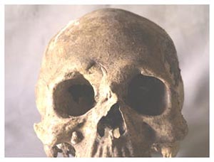 Figure 1. Male skull showing healed antemortem fractures of the right side of the face with resulting deformities of the nose and right eye orbit.